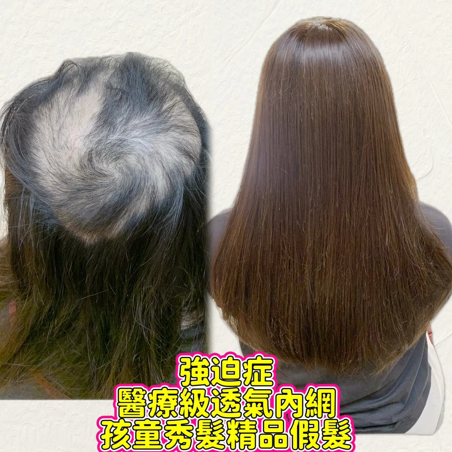 醫療級假髮｜醫療級透氣內網・側面對比 Before / After 對比照