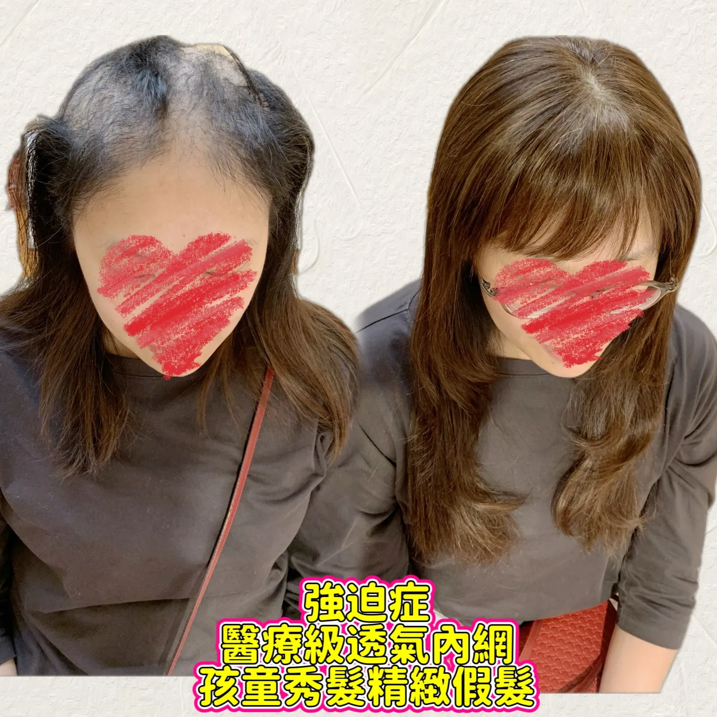 醫療級假髮｜醫療級透氣內網・正面對比 Before / After 對比照