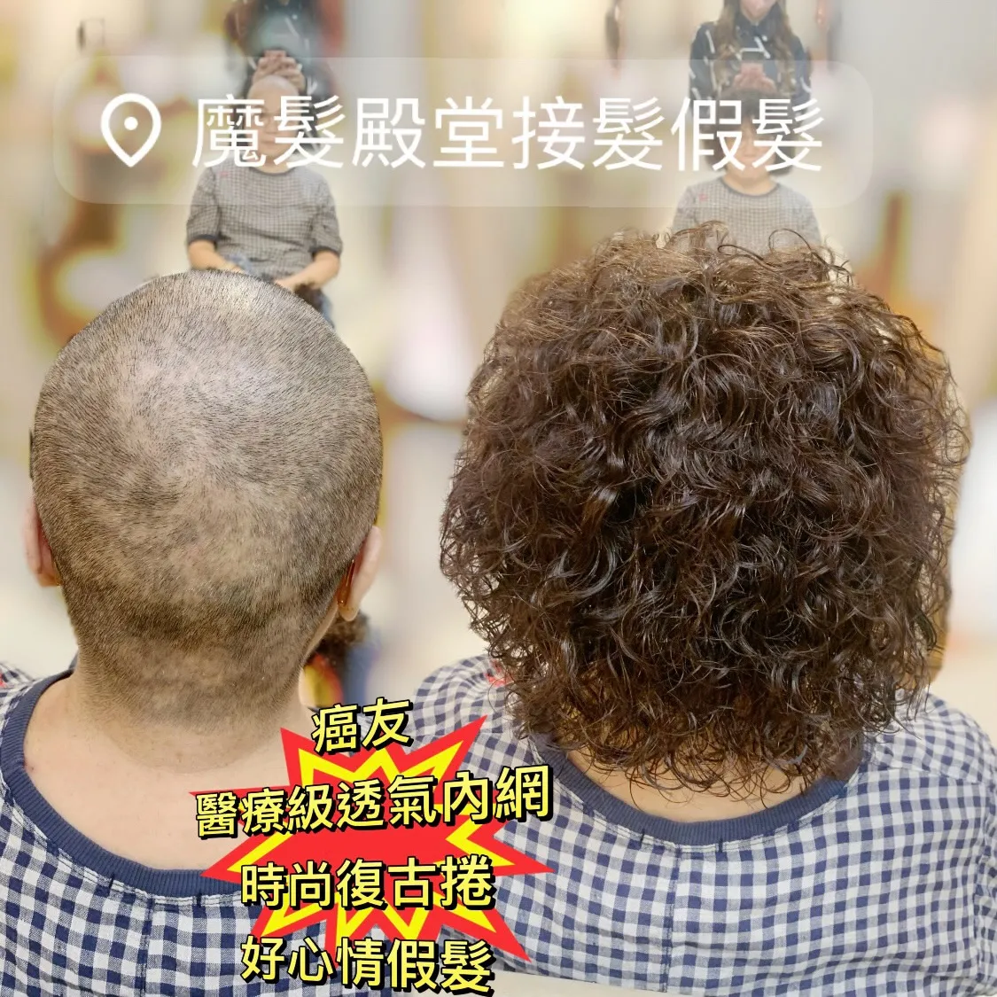 醫療級假髮｜醫療級透氣內網假髮（後視） Before / After 對比照