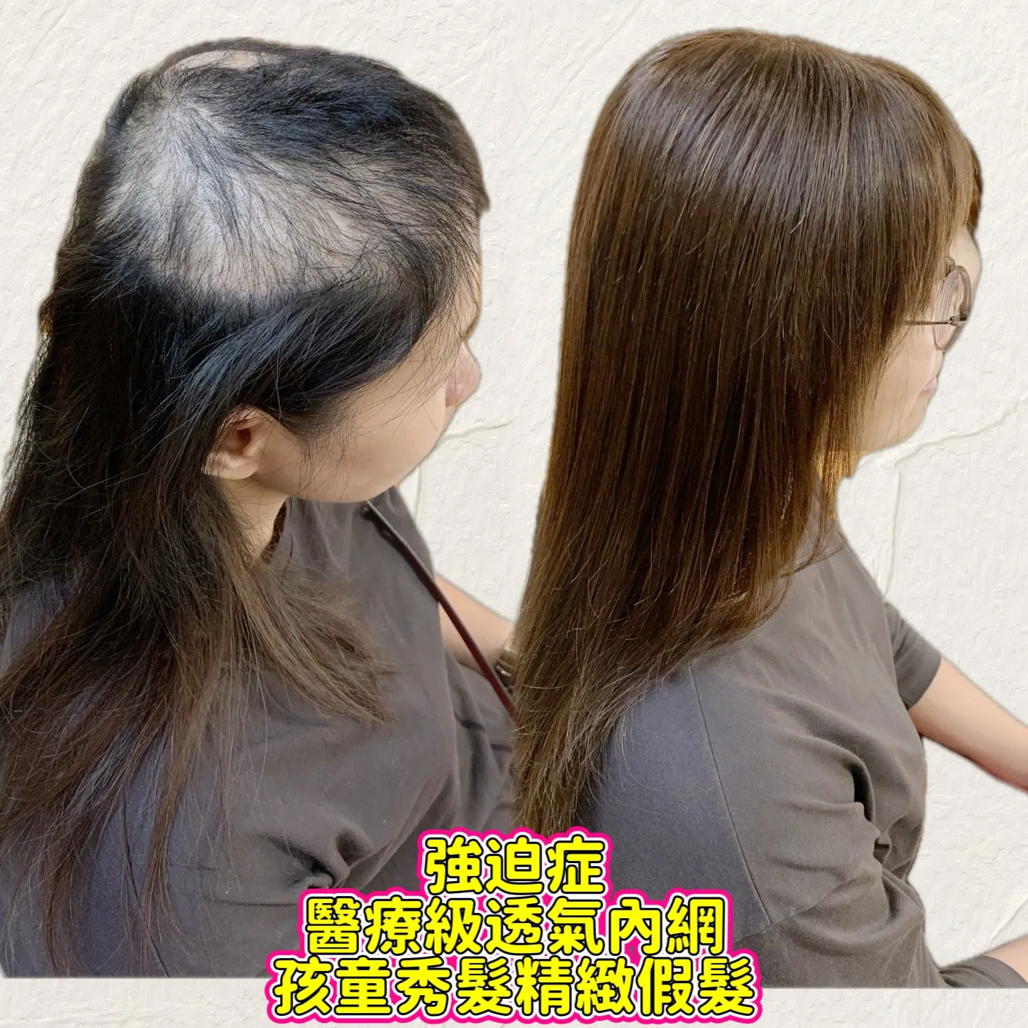 醫療級假髮｜醫療級透氣內網・側面對比 Before / After 對比照