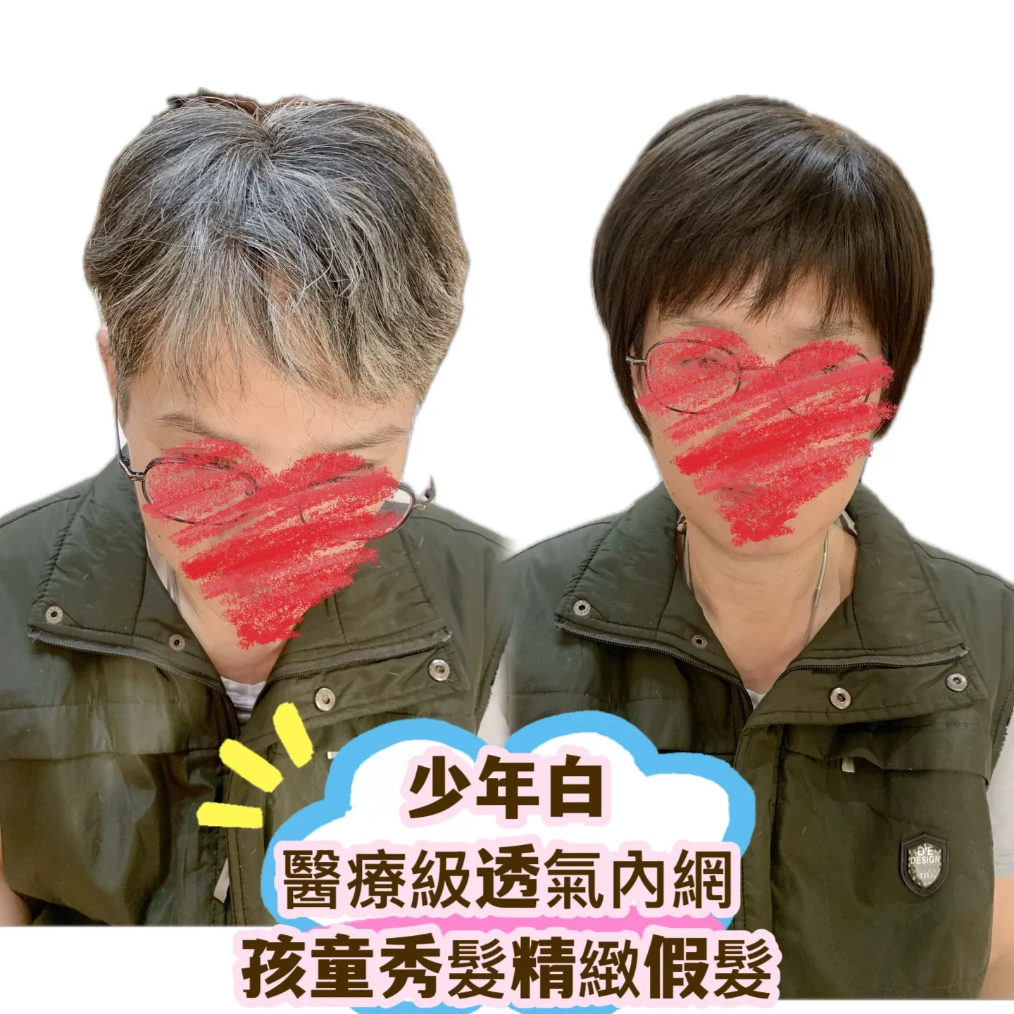 醫療級假髮｜少年白遮蓋・醫療級透氣內網 Before / After 對比照