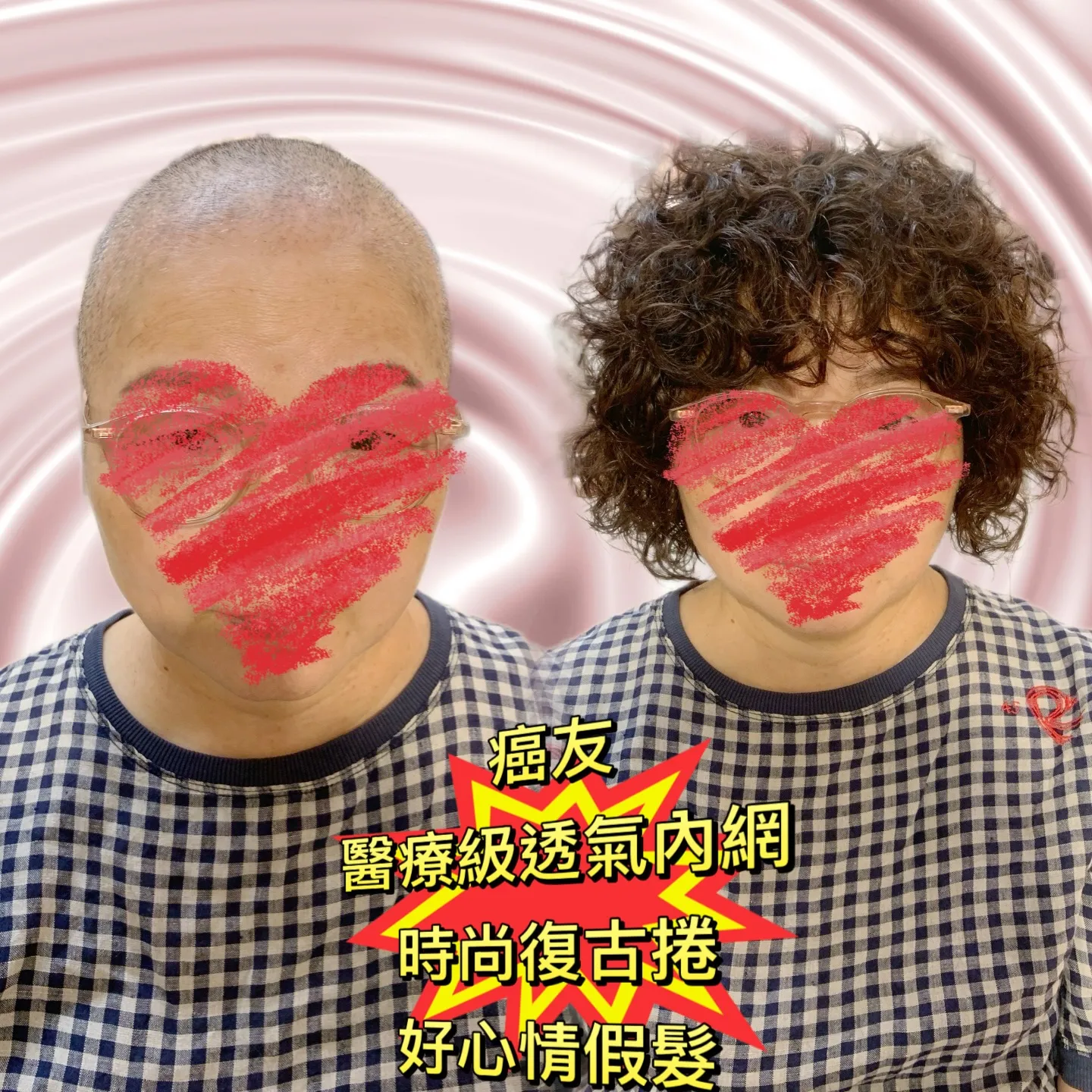 醫療級假髮｜醫療級透氣內網假髮（正面） Before / After 對比照