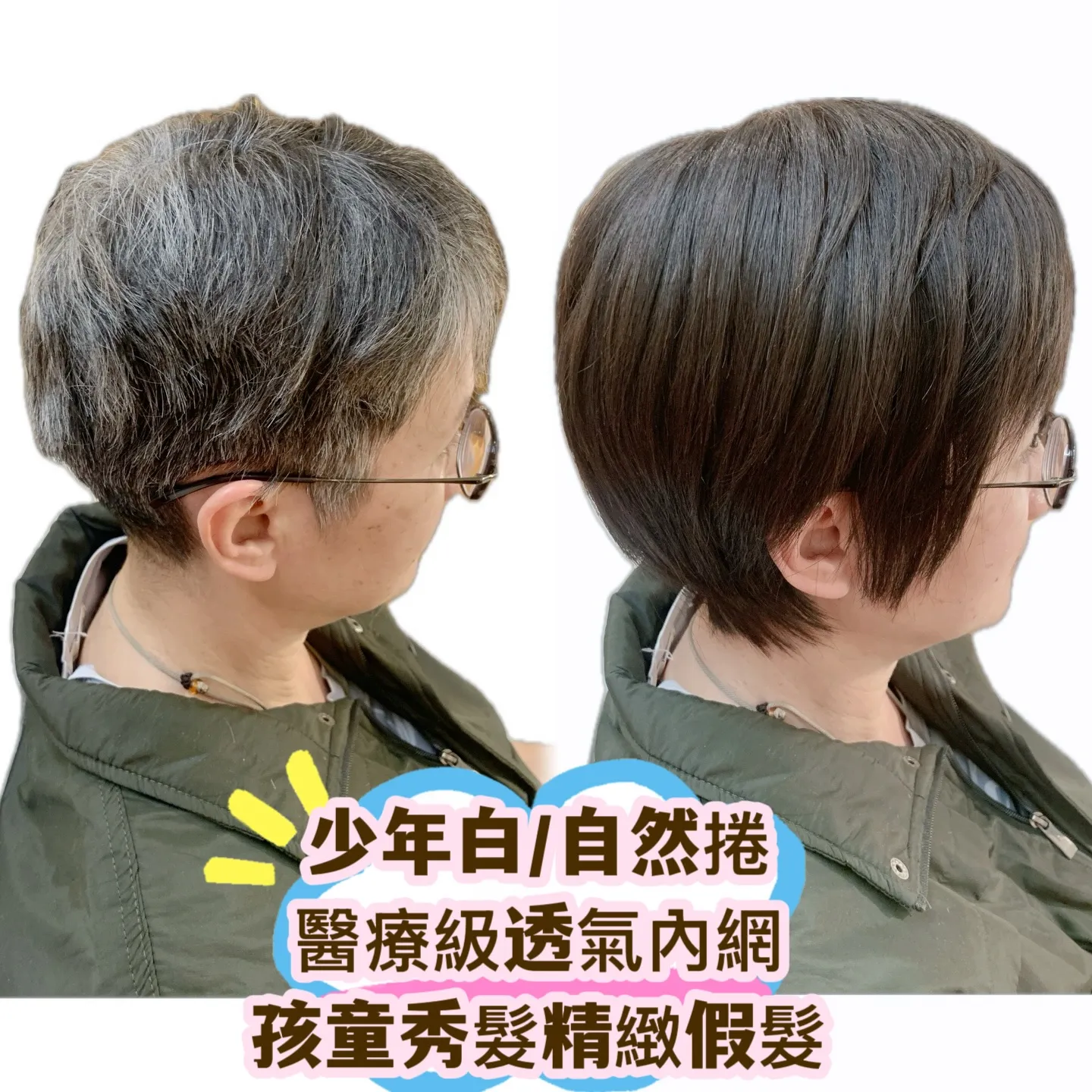 醫療級假髮｜少年白／自然捲・側面對比 Before / After 對比照