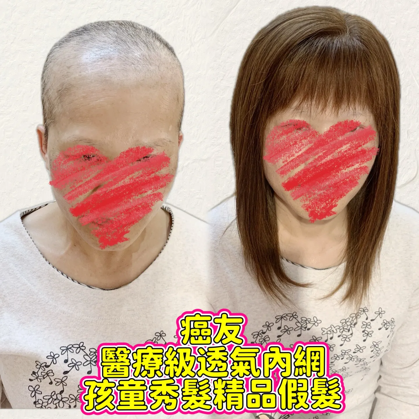 醫療級假髮｜醫療級透氣內網・正面對比 Before / After 對比照