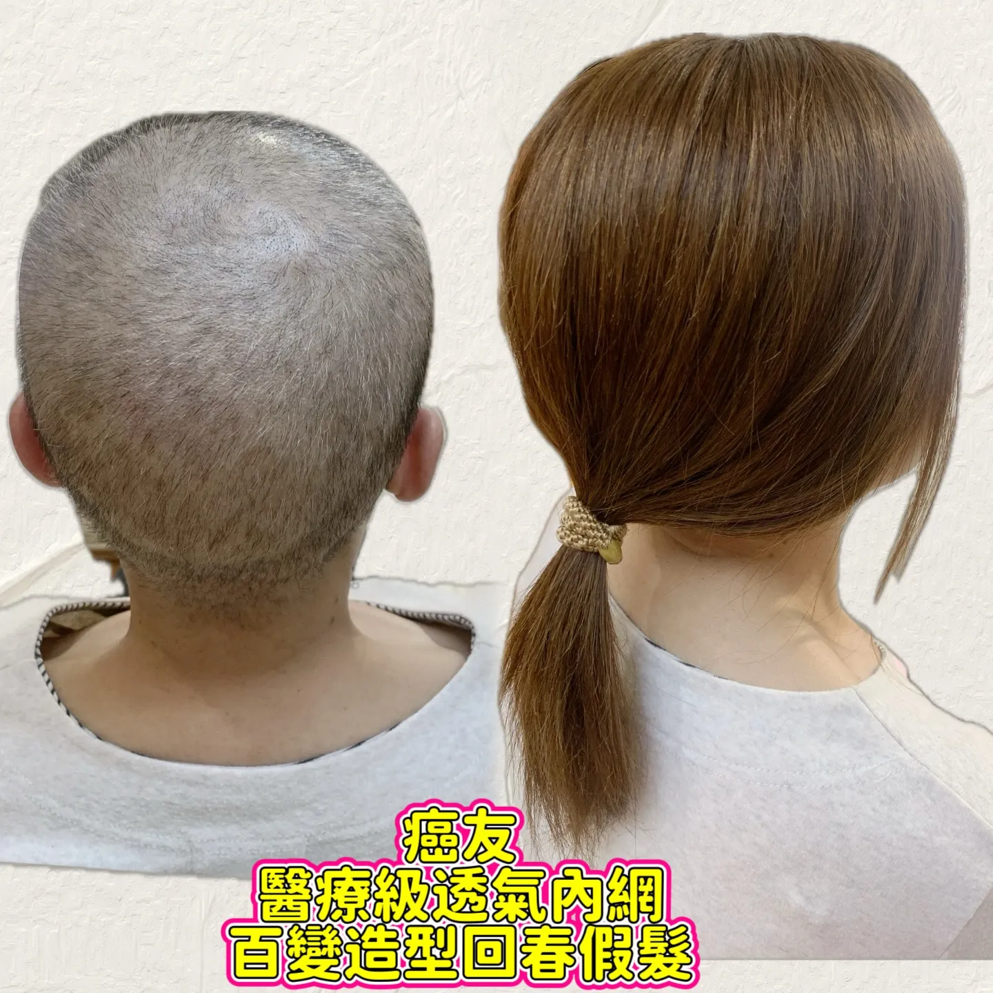 醫療級假髮｜醫療級透氣內網・後視對比 Before / After 對比照