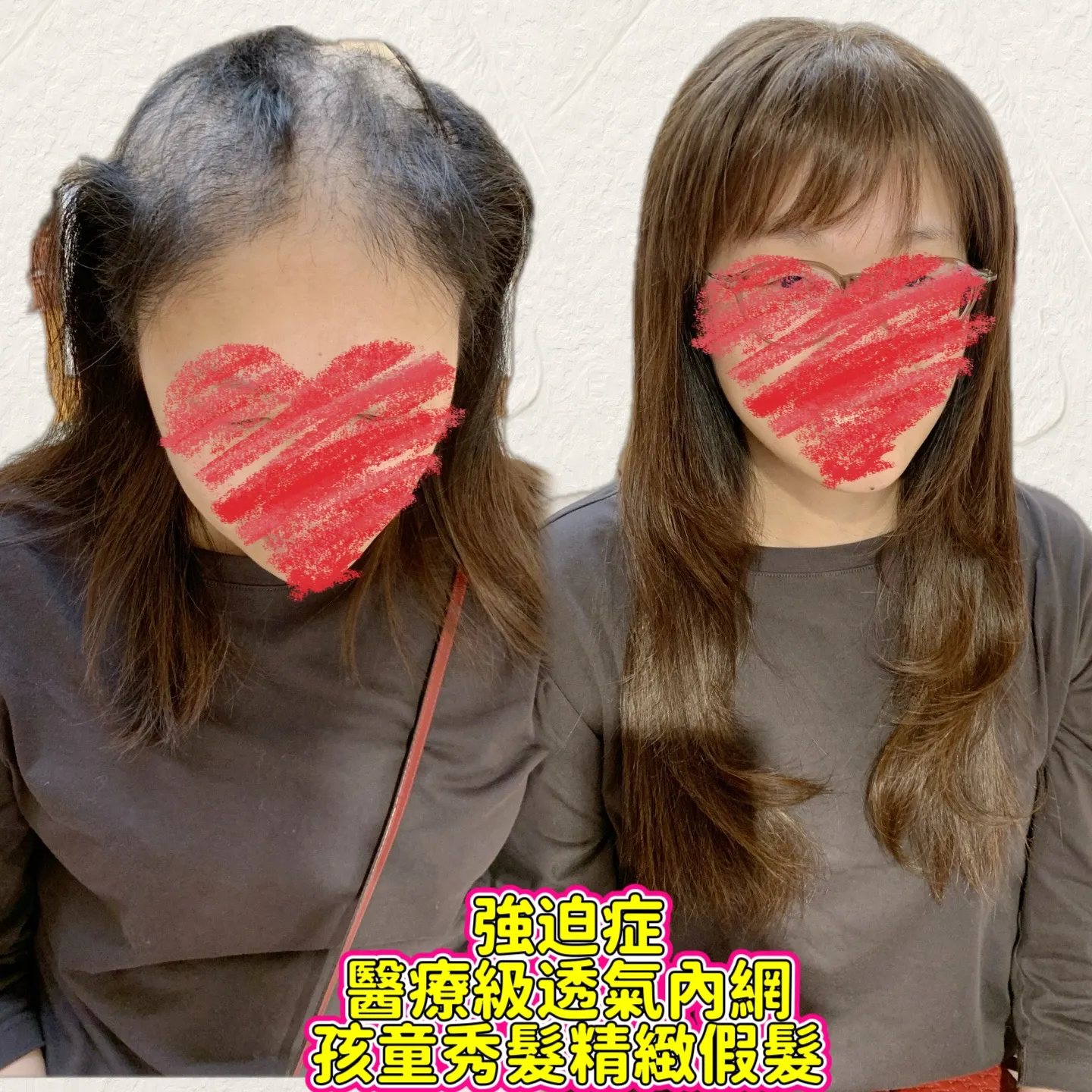 醫療級假髮｜醫療級透氣內網・正面對比 Before / After 對比照
