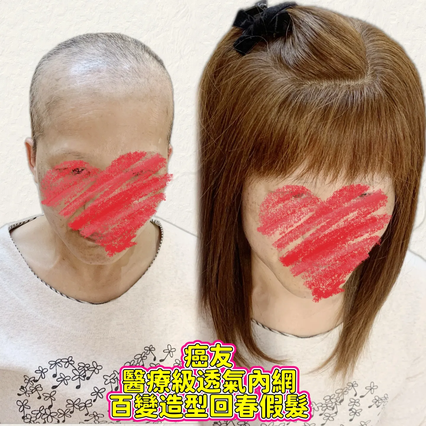 醫療級假髮｜醫療級透氣內網・百變造型 Before / After 對比照