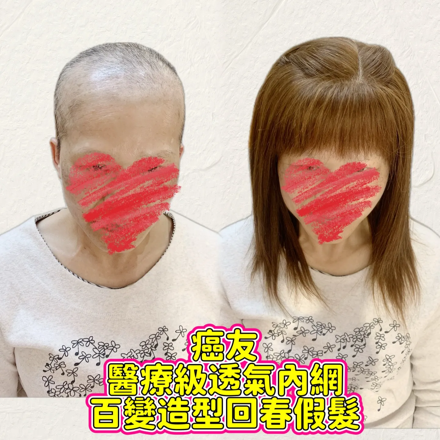 醫療級假髮｜醫療級透氣內網・正面對比 Before / After 對比照