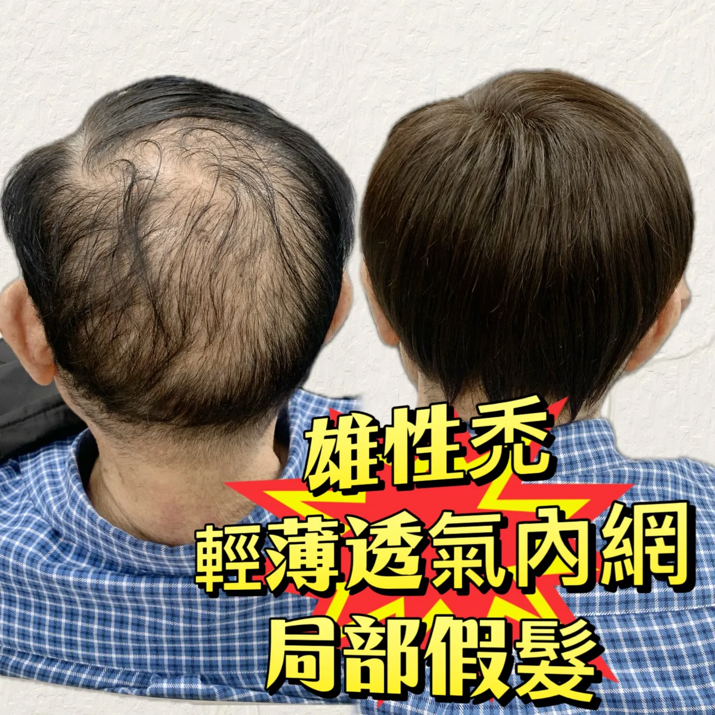 男士假髮｜雄性禿・局部假髮後視對比 Before / After 對比照