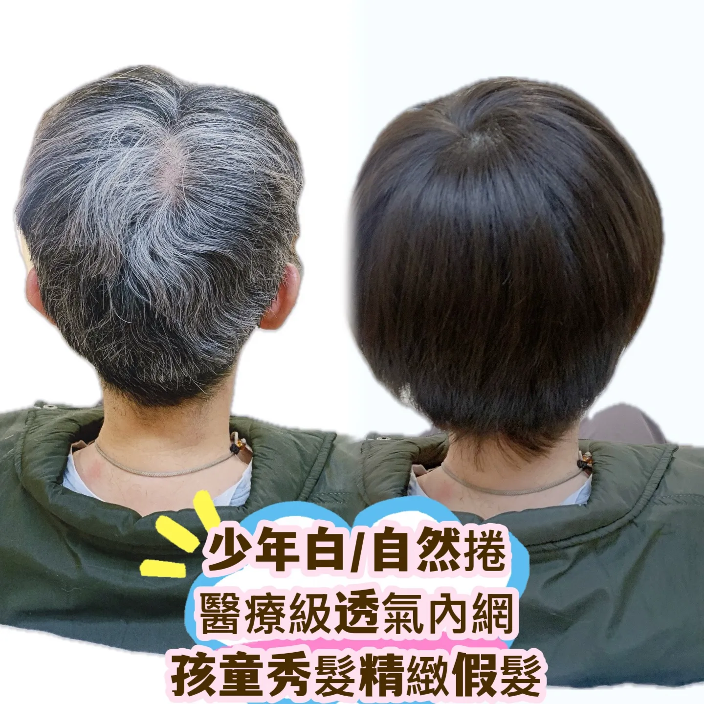 醫療級假髮｜少年白／自然捲・後視對比 Before / After 對比照