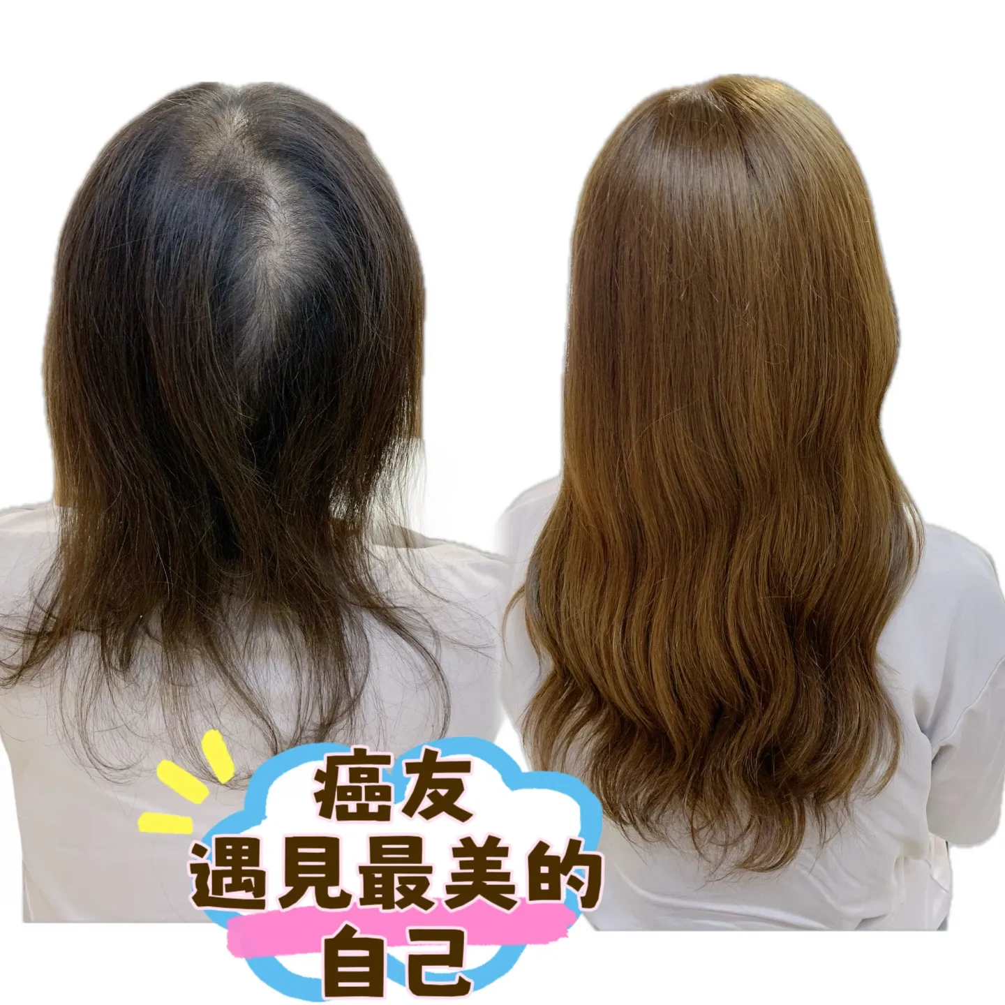 醫療級假髮｜遇見最美的自己・後視對比 Before / After 對比照