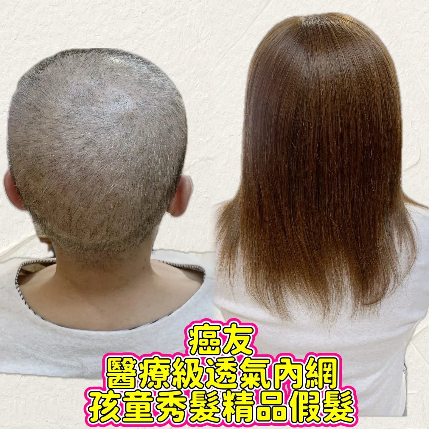 醫療級假髮｜醫療級透氣內網・後視對比 Before / After 對比照